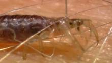 Body lice video